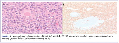 Figure 1 A, Mature plasma cells surrounding follicles and CD138 positive plasma cells in thyroid