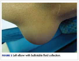 Figure 2 Left elbow with ballotable &lt;?AID 001f?&gt;uid collection.