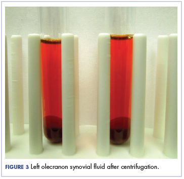 Figure 3 Left olecranon synovial &lt;?AID 001f?&gt;uid after centrifugation.