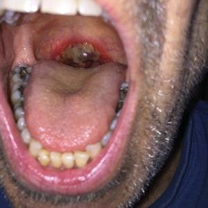 Friable Erythema and Erosions on the Mouth | MDedge