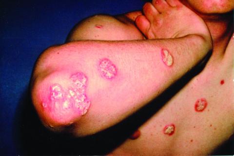 Psoriasis on elbow