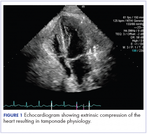 Figure 1. Echocardiogram showing intrinsic compression of the heart resulting in tamponade physiology.