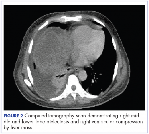Figure 2. Computed-tomography scan demonstrating right middle and lower lobe atelectasis and right ventricular compression by liver mass.