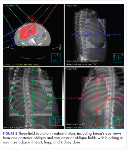 Figure 3. Three-<?AID 001e?>field radiation treatment plan, including beam’s eye views from one posterior oblique and two anterior oblique <?AID 001e?>fields with blocking to minimize adjacent heart, lung, and kidney dose.