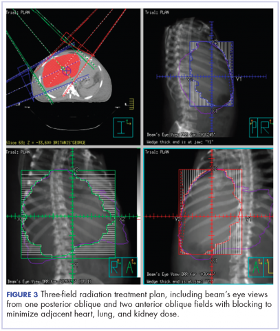 Figure 3. Three-&lt;?AID 001e?&gt;field radiation treatment plan, including beam’s eye views from one posterior oblique and two anterior oblique &lt;?AID 001e?&gt;fields with blocking to minimize adjacent heart, lung, and kidney dose.