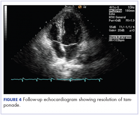 Figure 4. Follow-up echocardiogram showing resolution of tamponade.