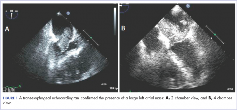 Figure 1. Transesophageal echocardiogram confirms presence of large left atrial mass.