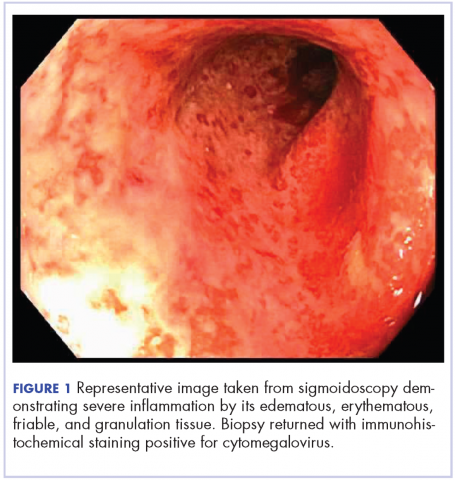 Figure 1. Image from sigmoidoscopy showing severe infl&lt;?AID 001f?&gt;ammation by its edematous, erythematous, friable, and granulation tissue.