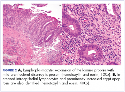 Figure 2. Image A, Lymphoplasmacytic expansion of the lamina propria with mild architectural disarray. Image B, Increased intraepithelial lymphocytes and prominently increased crypt apoptosis.