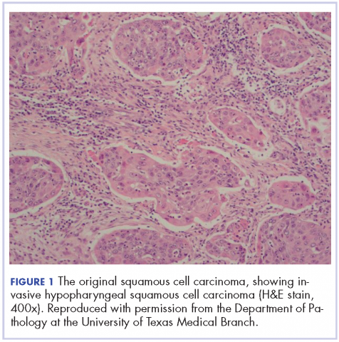 Figure 1. The original SCC, showing invasive hypopharyngeal squamous cell carcinoma (H&amp;E stain, 400x).