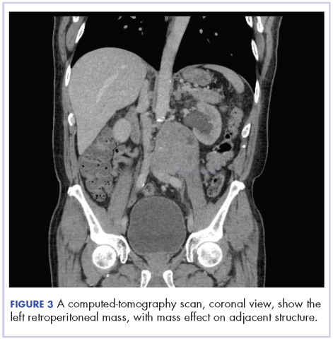 Figure 3. A CT scan, coronal view, shows the left retroperitoneal mass, with mass effect on adjacent structure.