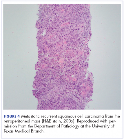 Figure 4. Metastatic recurrent SCC from the retroperitoneal mass (H&amp;E stain, 200x).