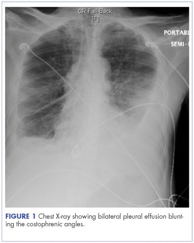 Bilateral chylothorax in an AIDS patient with newly diagnosed Kaposi ...