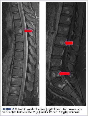 Figure 3 Osteolytic vertebral lesions in the L2 and L5 vertebrae