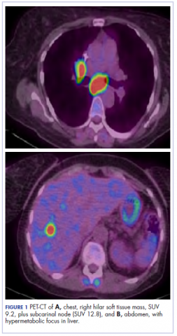 Figure 1. PET showing soft tissue mass