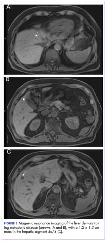 Figure 1. MRI showing metastatic disease