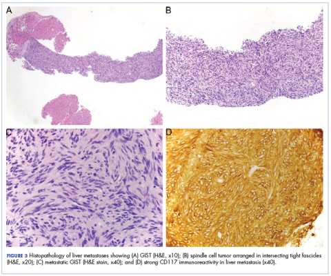 Figure 3. Histopathology of metastsis