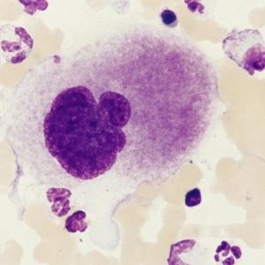 Thrombocytopenia and neutropenia: A structured approach to evaluation
