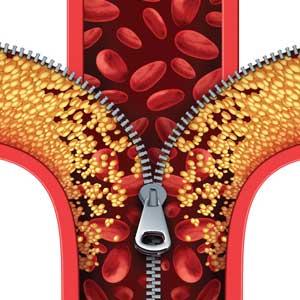 How Do I Use the New Cholesterol Guidelines?