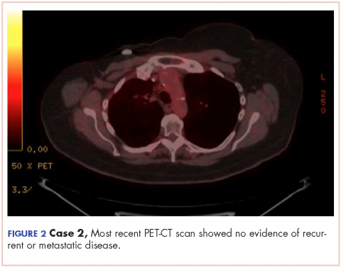 Figure 2, Case 2 Recent PET-CT scan showing no metastatic disease