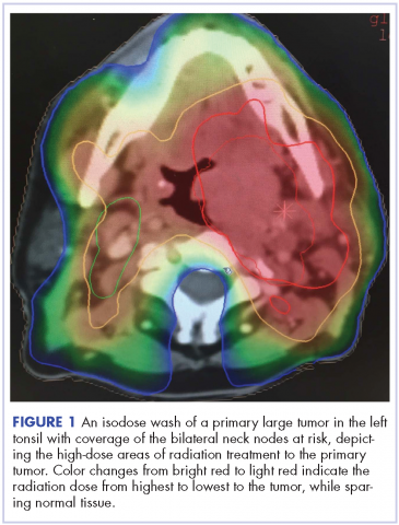 Figure 1 Isodose wash of a primary tumor in the left tonsil