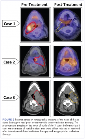 figure 2 PET imaging of all 3 cases, pre- and post-treatment