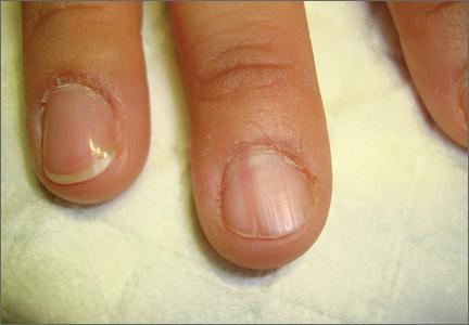 Painful Nail with Longitudinal Erythronychia | MDedge