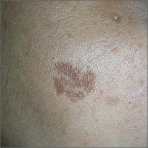 Brown spot on cheek