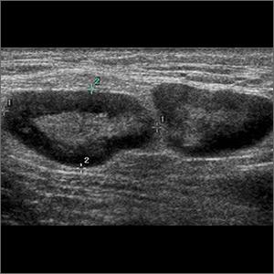 6-day history of fever • groin pain and swelling • recent hiking trip in Colorado • Dx?