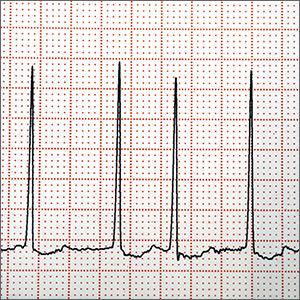 Does left atrial appendage closure reduce stroke rates as well as oral anticoagulants and antiplatelet meds in A-fib patients?