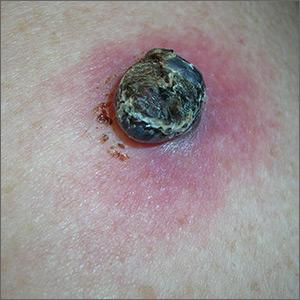 Black lesion on arm