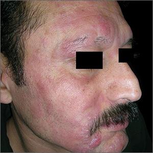 Rash with hair loss
