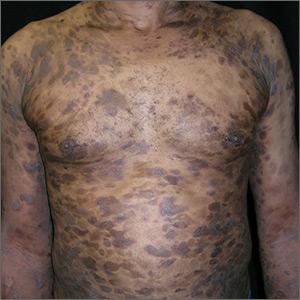 Widespread hyperpigmented plaques