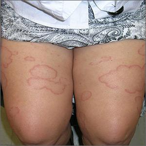 Geometric rash on arms and legs
