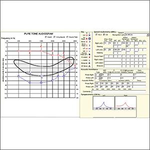 Acute hearing loss, tinnitus, and fullness in the left ear • Weber test lateralized to the right ear • Positive Rinne test and normal tympanometry • Dx?