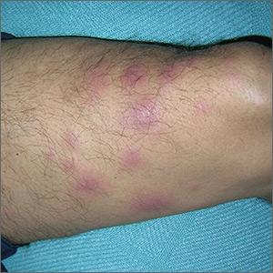Tender nodules after leprosy Tx