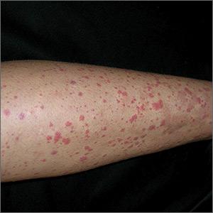 Nonthrombocytopenic purpuric rash of Henoch-SchÖnlein purpura