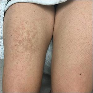 A reticulated, hyperpigmented patch on the right thigh