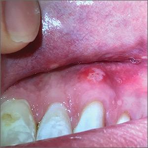Irregular ulcerations with a yellowish membrane and erythematous halo on the gingiva