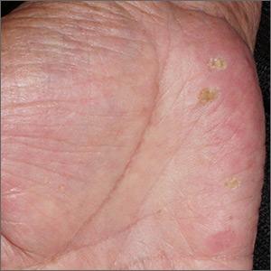 Papules on hand