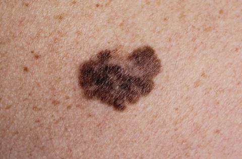 Melanoma