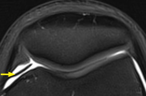 MRI identifies the source of the problem