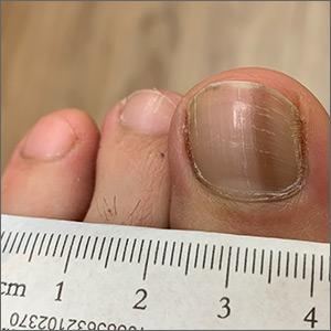 Dark toenail line