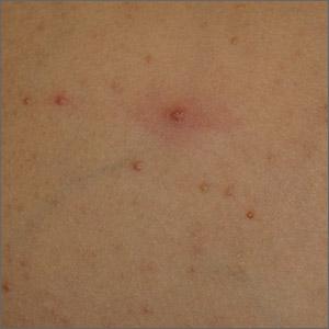 Chest papule