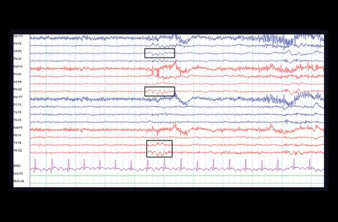 EEG revealed cortical hyperexcitability