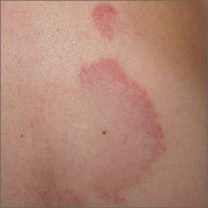 Arcuate eruption on the back