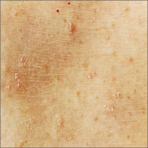 Scaly lesions