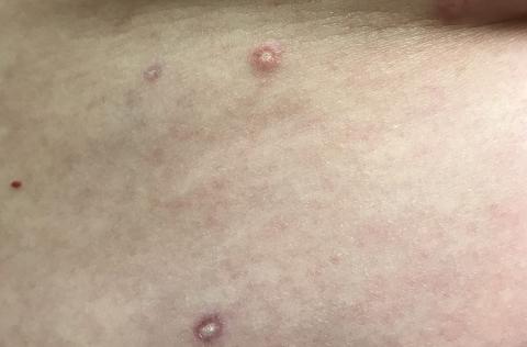 red marks on skin