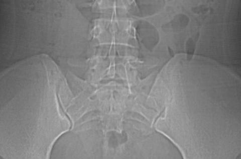 Nonobstructive bowel gas pattern