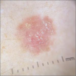 Scaly lesion on forearm